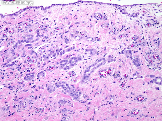 Peritoneum_MesothelialHyperplasia19_Hydrocele.jpg