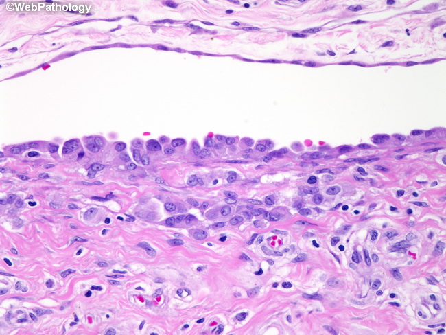 Peritoneum_MesothelialHyperplasia22_Hydrocele.jpg