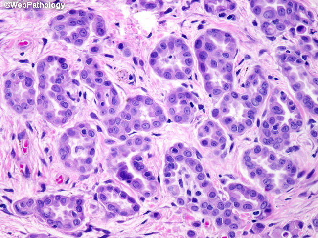 Peritoneum_MesothelialHyperplasia23_Hydrocele.jpg