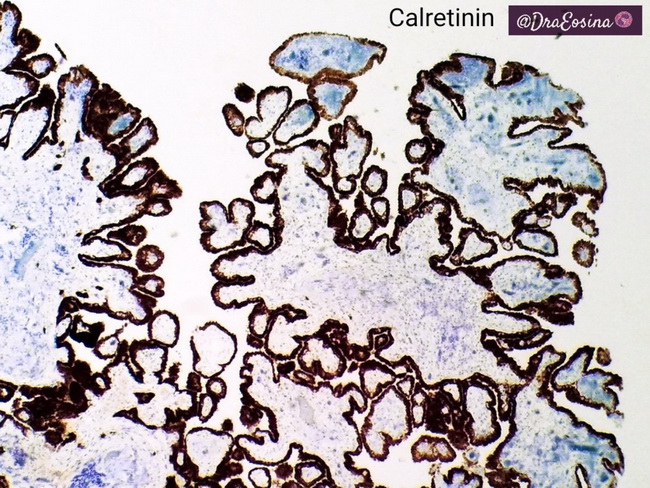 Peritoneum_MesothelialHyperplasia_Calretinin.jpg