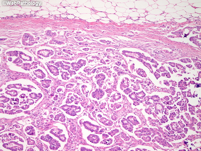 Peritoneum_Metastases_PapSerousCA1.jpg