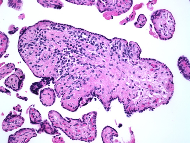 Placenta_LymphoplasmacyticVillitis1.jpg