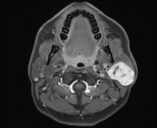 pleomorphic adenoma parotid radiology)