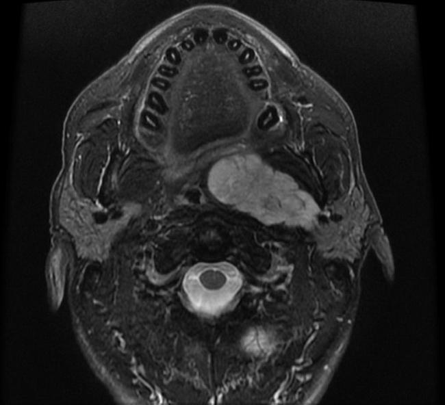 PleomorphicAdenoma_Radiology3_resized.jpg