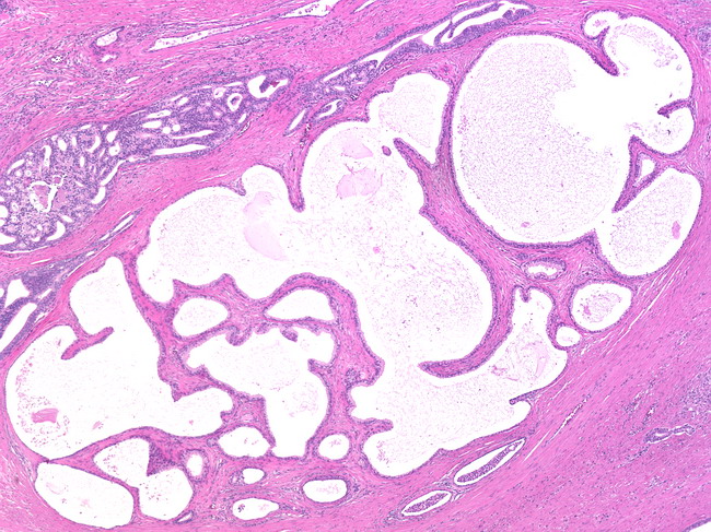 Papilloma upper urinary tract