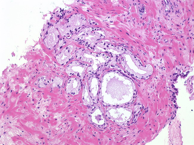 prostate atrophy pathology outlines prostatita si mexidol