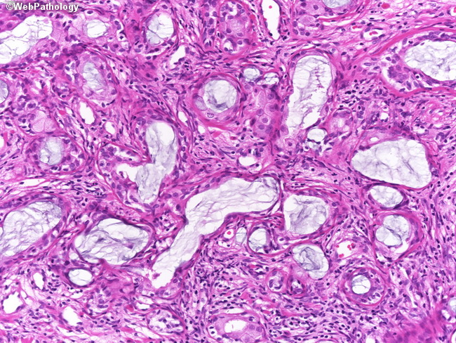 Prostate_BMCaP_SclAdenosis_E2.jpg
