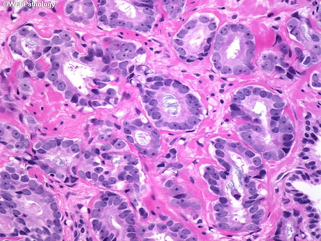 prostatic adenocarcinoma histology)