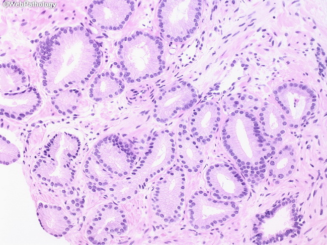 Gastric cancer pathology outlines - Condyloma acuminatum natural treatment