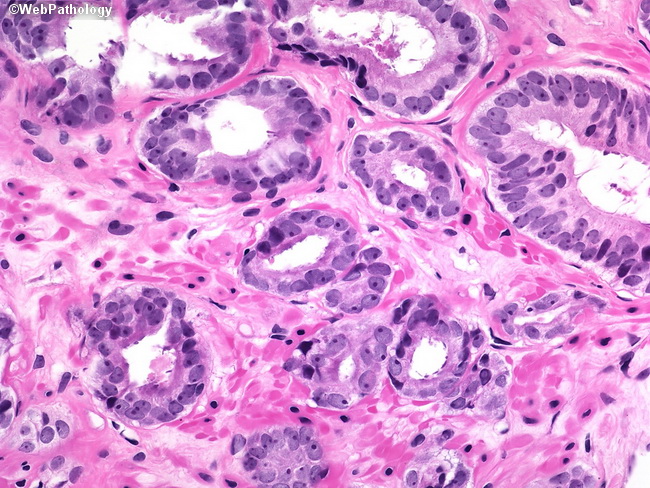prostate adenocarcinoma webpathology)