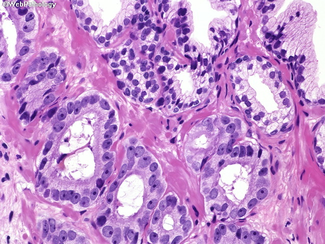 prostate adenocarcinoma webpathology