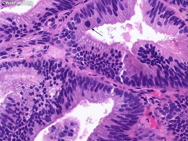 prostatic adenocarcinoma small acinar type