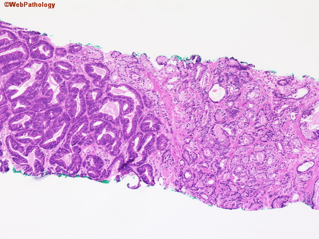 histopathology of prostate adenocarcinoma)