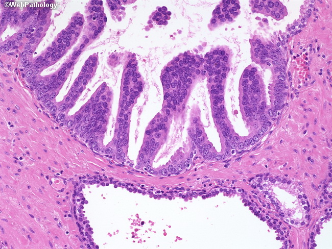 Prostate_HGPIN_Micropapillary1_Resized.jpg