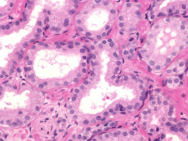 Papillary urothelial pathology outlines. Teren de vanzare gruiu ilfov