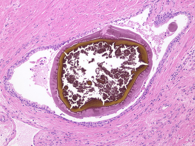 corpus amylacea prostate A prostatitis jelei