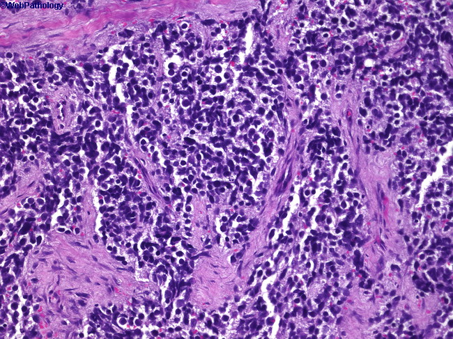 Rhabdomyosarcoma_Alveolar1(1).jpg
