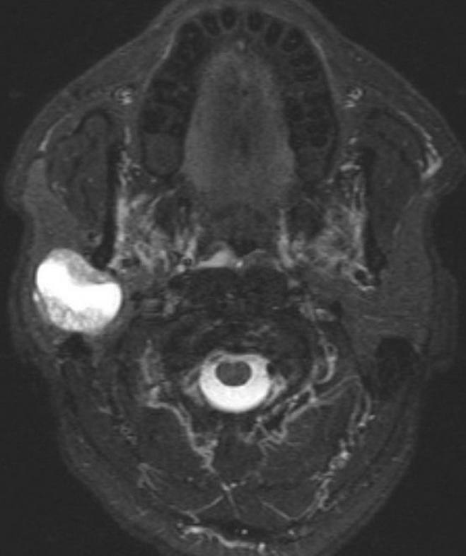 SalivaryGlands_AcinicCellCA_Radiology1_resized.jpg