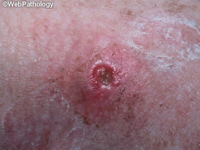 Skin_ArthropodBite1_Ulcer.jpg