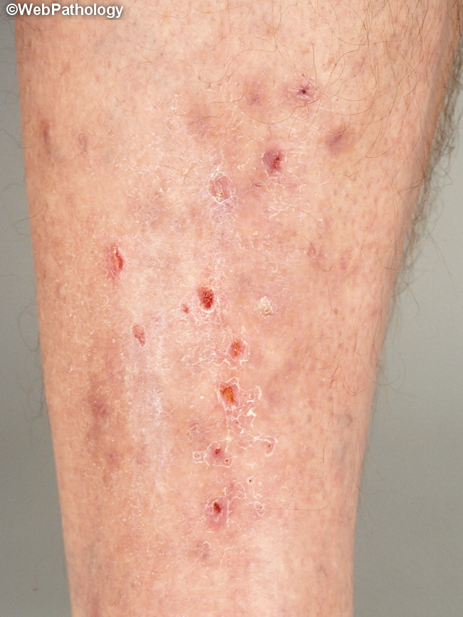 Skin_DermatitisHerpetiformis2.jpg