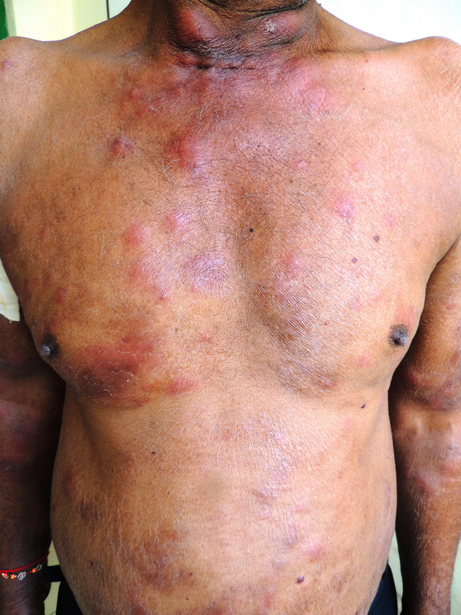Skin_Infections_Leprosy2_resized.jpg