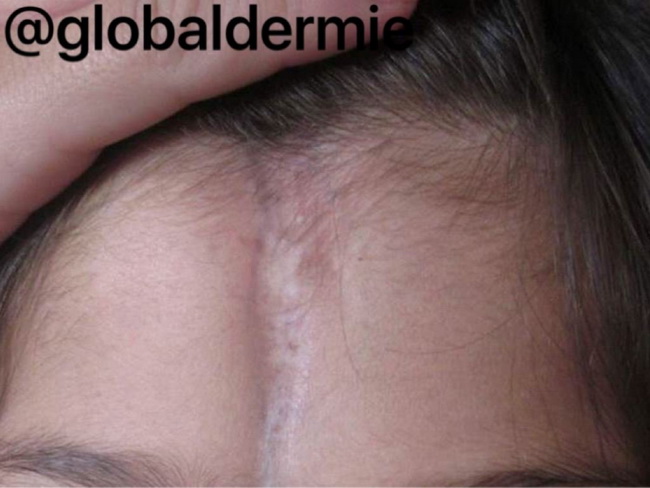 Skin_Scleroderma26_Morphea.jpg