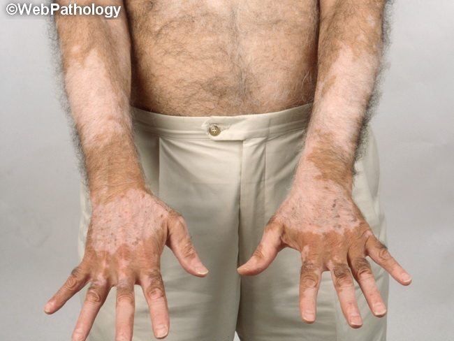 Skin_Vitiligo2.jpg