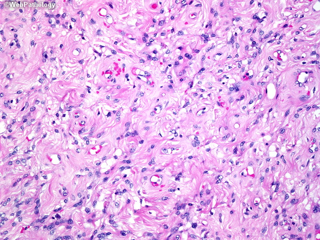 SoftTissue_Angiomyofibroblastoma.jpg