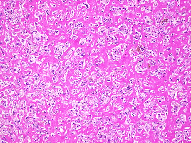 SoftTissue_Fibrohistiocytic_FibrousHistiocytoma_Lipidized_Leg2.jpg