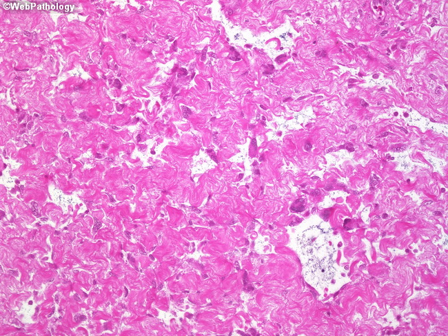 SoftTissue_Fibrohistiocytic_GiantCellFibroblastoma1_Cropped.jpg