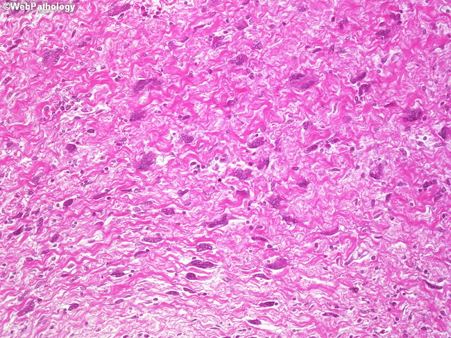 SoftTissue_Fibrohistiocytic_GiantCellFibroblastoma2_Cropped.jpg
