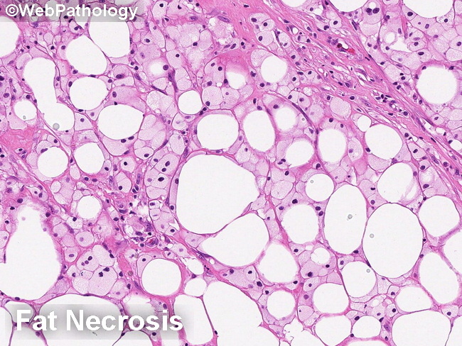 SoftTissue_LPS_Differential_FatNecrosis2A_resized.jpg