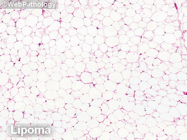SoftTissue_LPS_Differential_Lipoma2.jpg