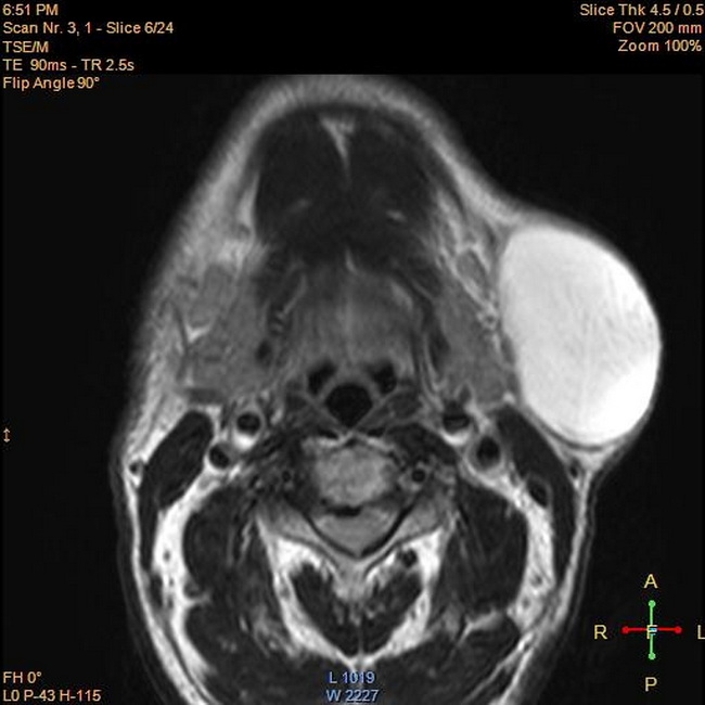 SoftTissue_Lipoma_Radiology1_resized.jpg