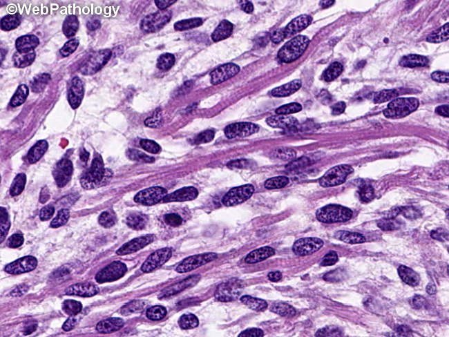 SoftTissue_RMS_Embryonal22.jpg