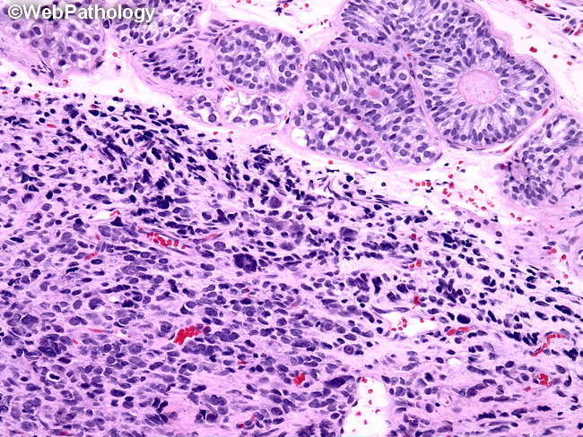 SoftTissue_Rhabdomyosarcoma_Alveolar28_Paratesticular.jpg