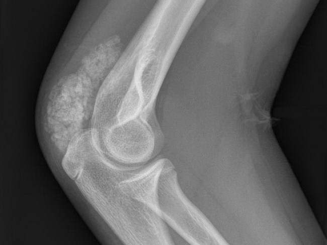 SoftTissue_TumoralCalcinosis_Imaging1A_resized.jpg