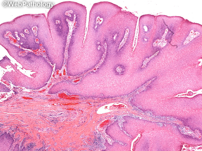 squamous papilloma of esophagus pathology
