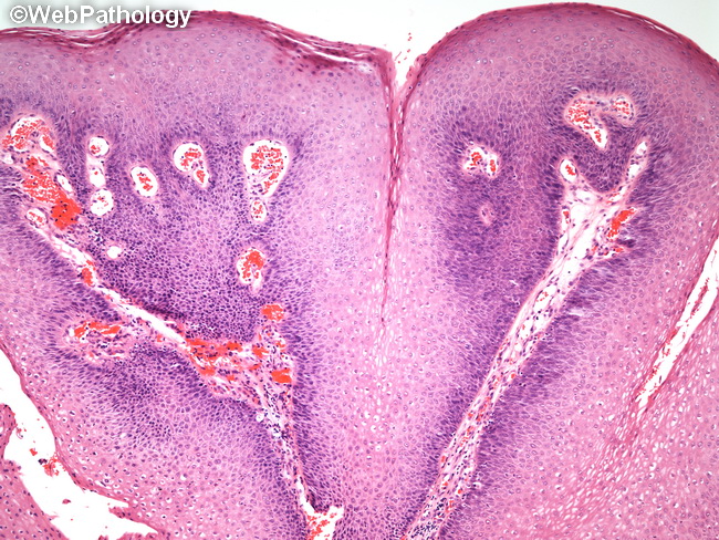 squamous papilloma vs fibroepithelial polyp