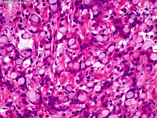 Full article: Exceptional Symbiosis Between Tumors: A Case of Gastric  Signet Ring Cell Metastasis in Chromophobe Carcinoma of the Kidney