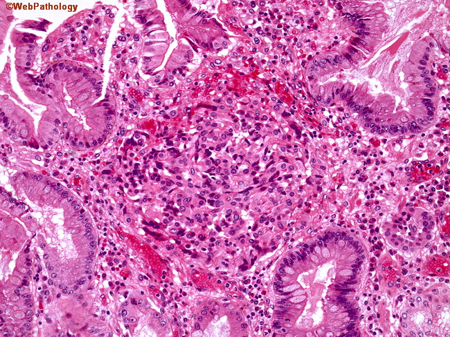 Stomach_ECL_Hyperplasia5_Microcarcinoid.jpg