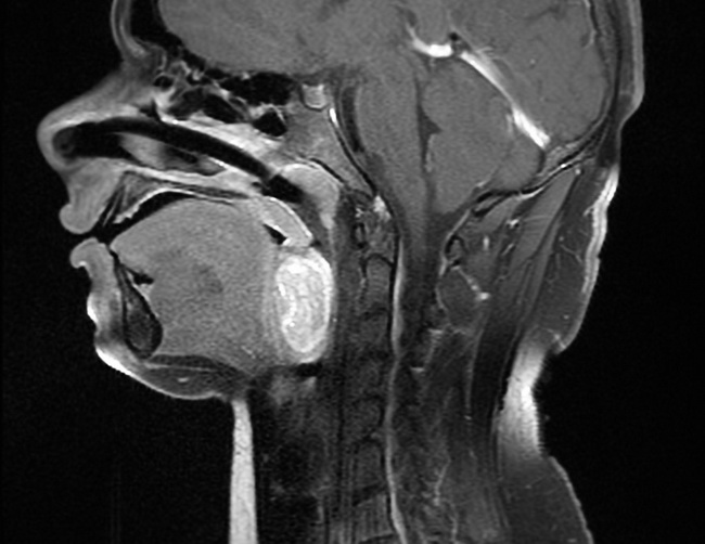 SynovialSarcoma_Radiology2B_resized.jpg