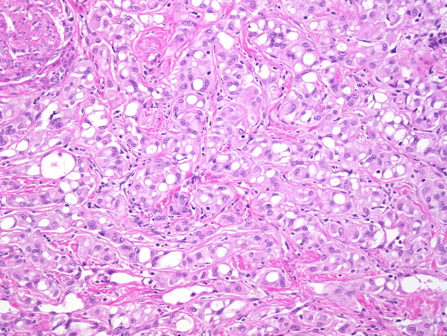 icd 10 code for squamous cell carcinoma in situ neck
