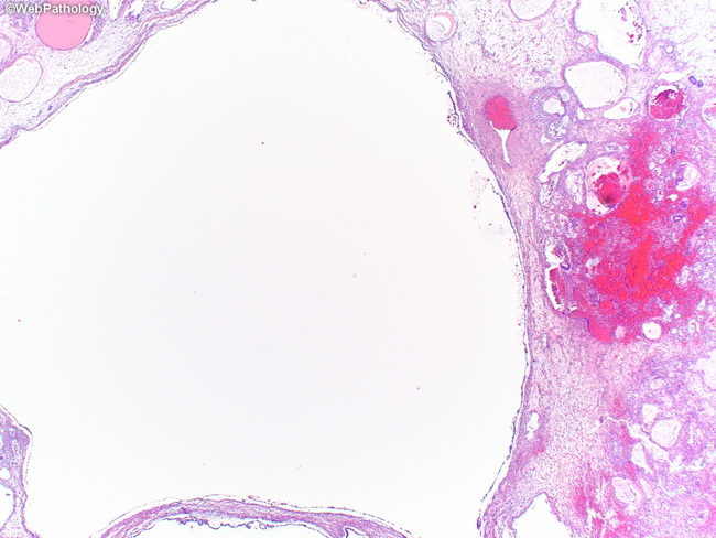 squeeze fare Abnormal Webpathology.com: A Collection of Surgical Pathology Images