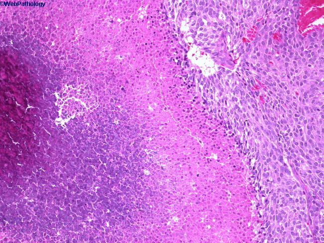 Thymus_AtypicalCarcinoid6.jpg