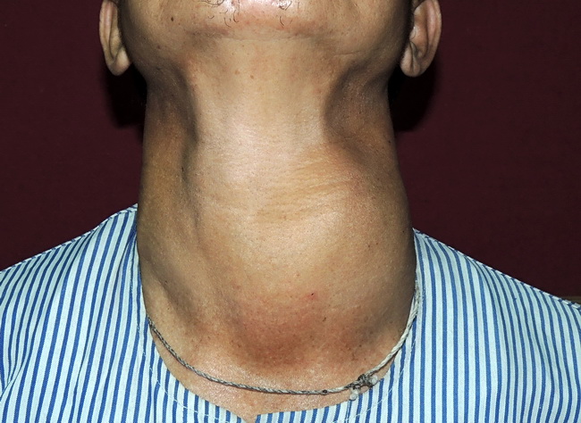Thyroid_FollicularCA2_Resized.jpg