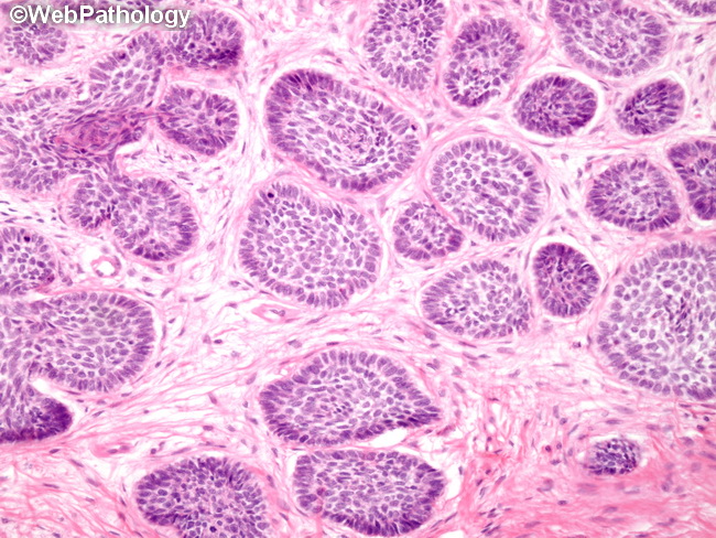 Basal Cell Carcinoma Histology
