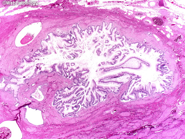 villous papilloma of urinary bladder medicamente imunitate scazuta