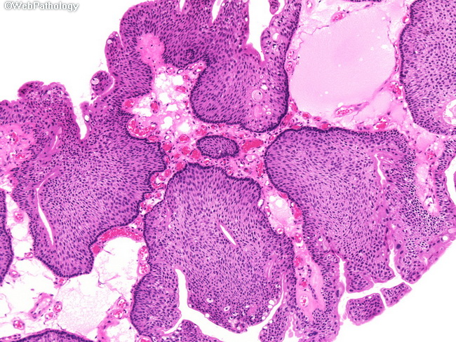 Inverted papilloma of bladder histology - Urothelial cell papilloma
