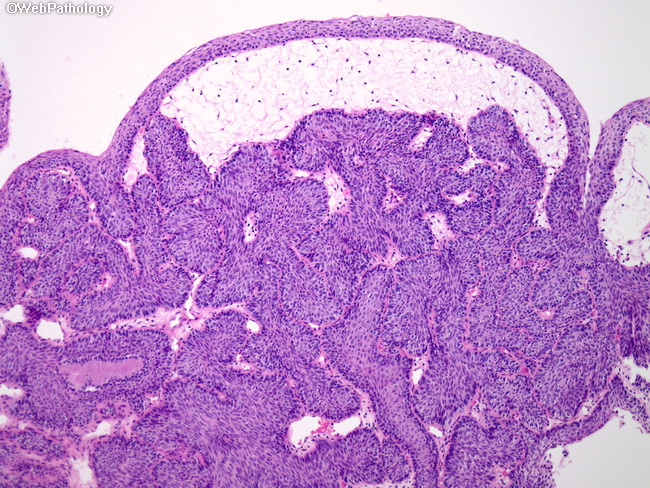 urinary bladder papilloma pathology